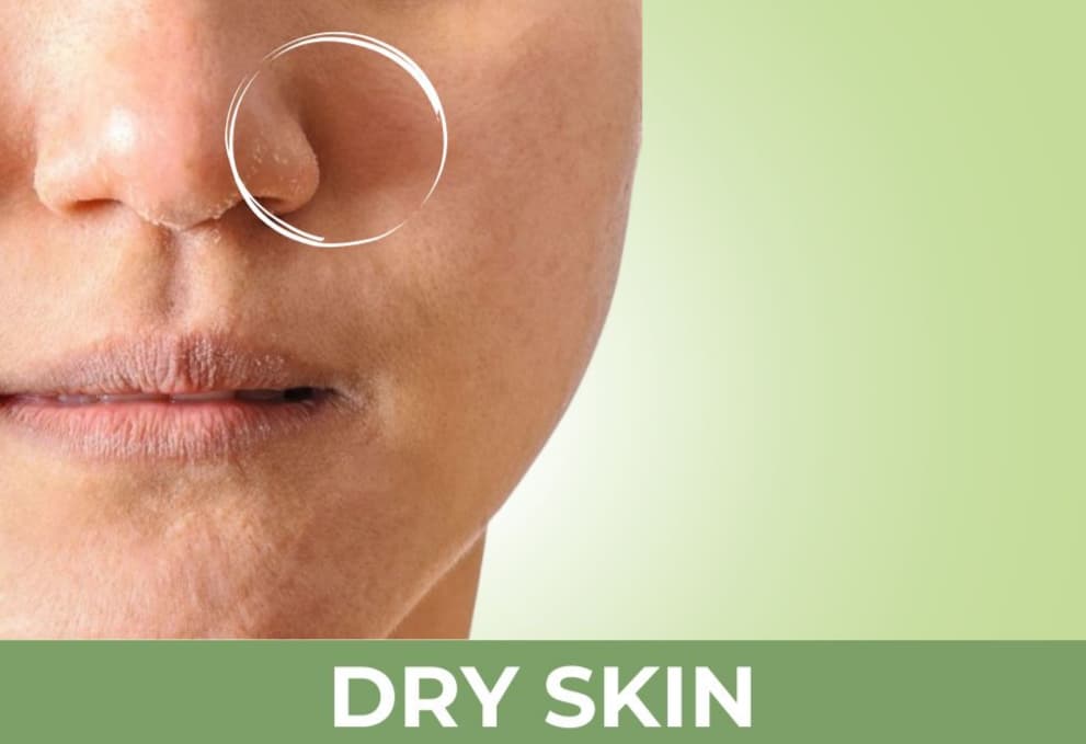 Dry Skin